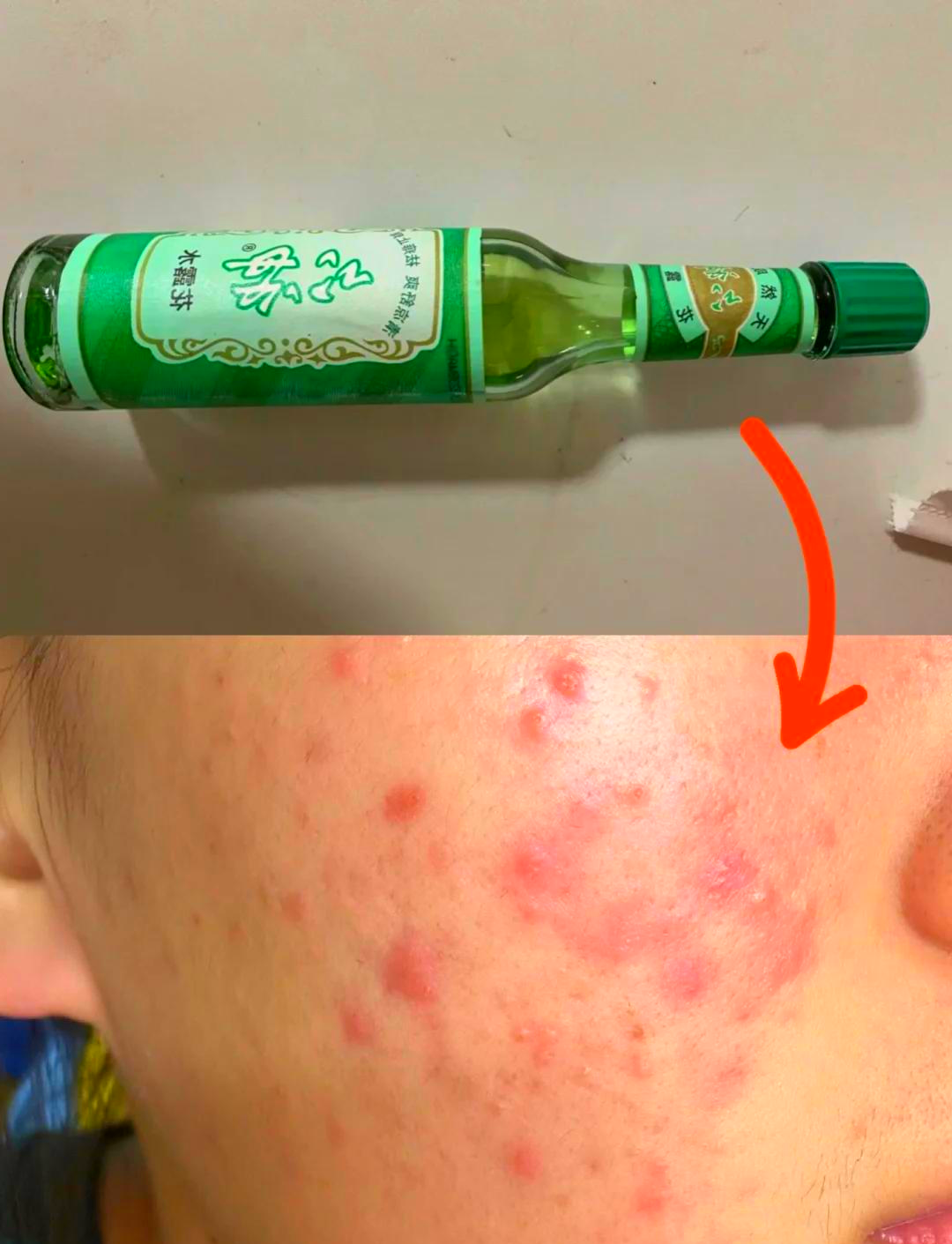 脸上有螨虫怎么去除简单方法